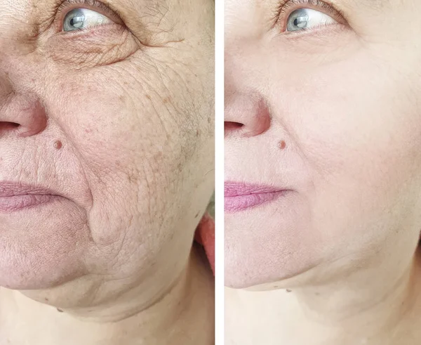 Face Elderly Woman Wrinkles Procedures — Stock Photo, Image