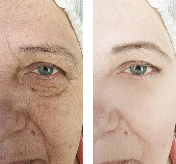 Face Elderly Woman Wrinkles Procedures — Stock Photo, Image