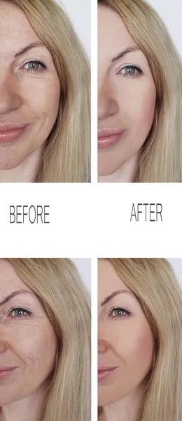 Cara Mujer Arrugas Antes Después Los Procedimientos —  Fotos de Stock