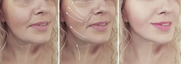 Kadın Kırışıklıkları Yüz Öncesi Tedavi Sonrası — Stok fotoğraf