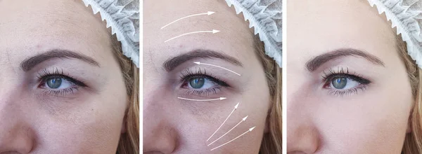 Arrugas Mujer Cara Antes Después Los Tratamientos Flecha — Foto de Stock