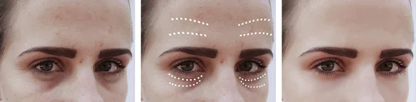 Dziewczyna Zmarszczki Oczu Przed Zabiegach — Zdjęcie stockowe