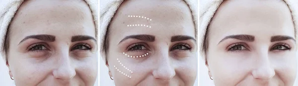 Eye Wrinkles Girl Procedures — Stock Photo, Image