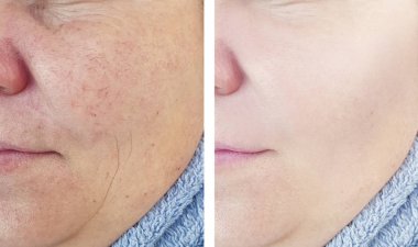 kadın kırışıklıkları öncesi ve sonrası yordamları