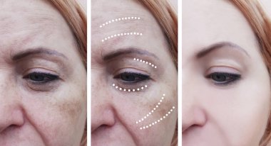 kadın kırışıklıkları önce ve sonra kaldırma