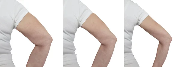 Vrouw Arm Vóór Gewichtsverlies — Stockfoto