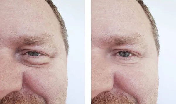 Mann Augen Blähungen Falten Vor Und Nach Eingriffen — Stockfoto