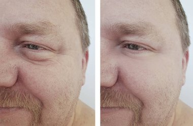 erkek gözler öncesi ve sonrası yordamları kırışıklıkları şişkinlik