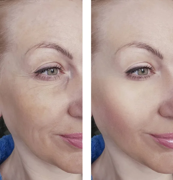 Arrugas Mujer Antes Después Terapia Tratamientos — Foto de Stock