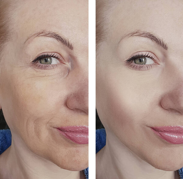 woman wrinkles before and after treatments therapy