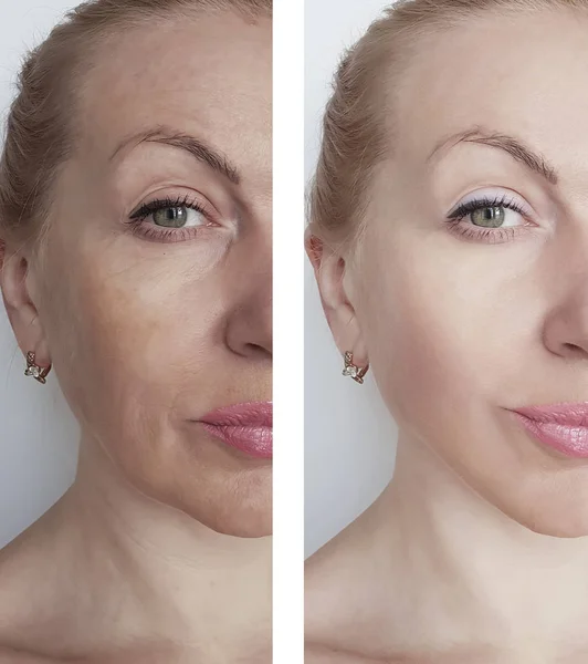 Arrugas Mujer Antes Después Terapia Tratamientos —  Fotos de Stock