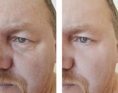 erkek önce ve yordamlar sonra şişkinlik kırışıklıkları gözleri