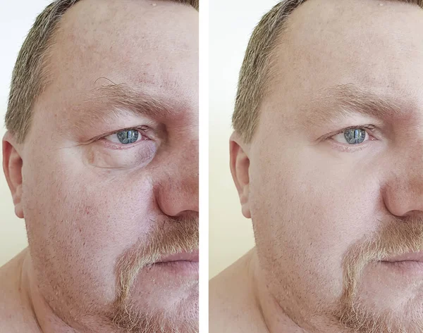 Αρσενικό Μάτια Ρυτίδες Φούσκωμα Πριν Και Μετά Από Διαδικασίες — Φωτογραφία Αρχείου