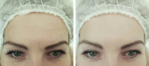 female forehead wrinkles before and after procedures