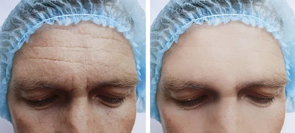 治療前と治療後の男性の額のしわ — ストック写真
