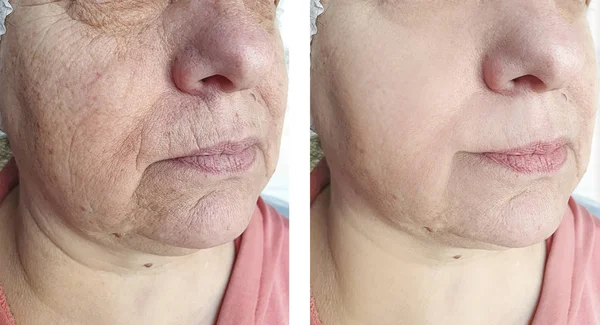 elderly woman face wrinkles before and after treatment