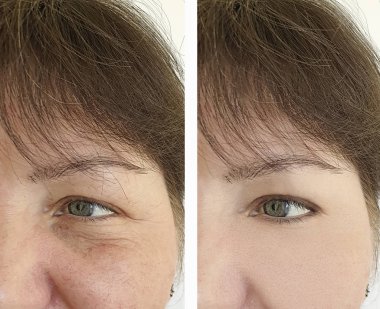 Yaşlı kadın yüz önce ve tedavi sonrası kırışıklıkları