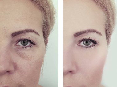 kadın önce ve sonra kozmetoloji prosedürleri kırışıklıkları