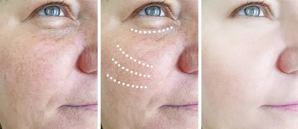 Woman Wrinkles Procedures Cosmetology — Stock Photo, Image
