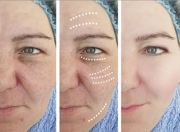 Wanita Keriput Sebelum Dan Sesudah Prosedur Kosmetologi — Stok Foto
