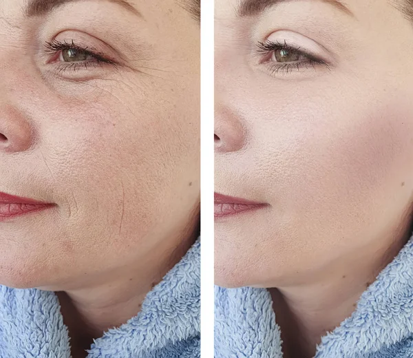 Wanita Menghadapi Keriput Sebelum Dan Setelah Prosedur Kosmetologi — Stok Foto