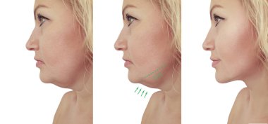 woman double chin sagging before and after procedures clipart