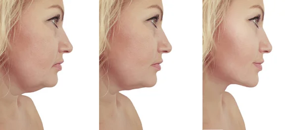 Woman Double Chin Sagging Procedures — Stock Photo, Image