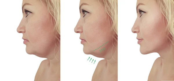 Woman Double Chin Sagging Procedures — Stock Photo, Image