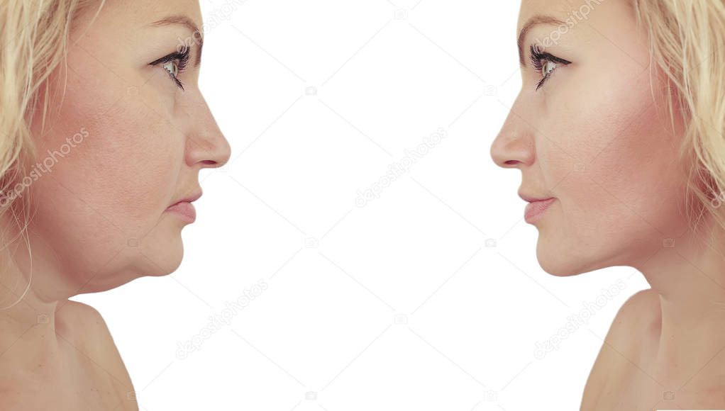 woman double chin sagging before and after procedures