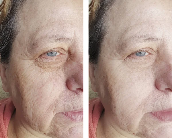 Πρόσωπο Μιας Γηραημένης Γυναίκας Αντιμετωπίζουν Ρυτίδες Πριν Και Μετά Τις — Φωτογραφία Αρχείου