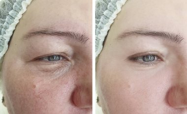 Yaşlı bir kadının yüzü önce ve sonra prosedürler kırışıklıkları yüz