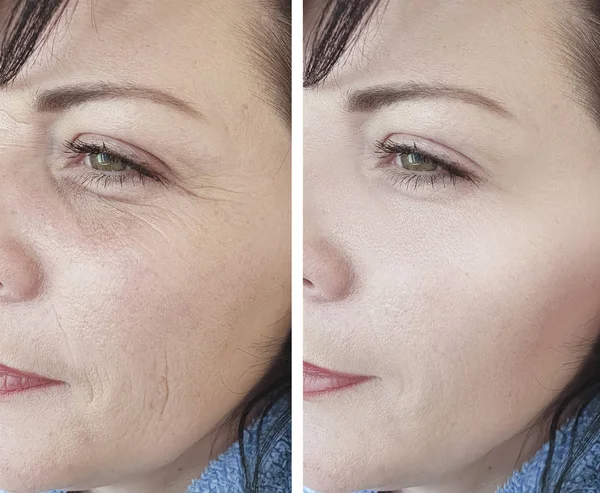 Wanita Keriput Wajah Sebelum Dan Setelah Koreksi Kecantikan — Stok Foto