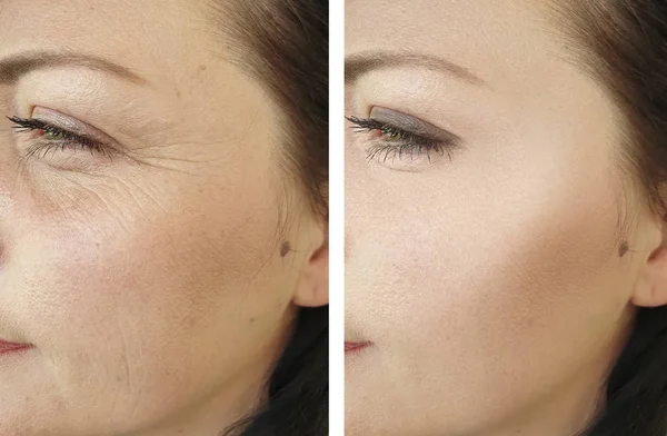 Wanita Keriput Wajah Sebelum Dan Setelah Koreksi Kecantikan — Stok Foto