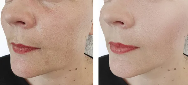 Frau Falten Gesicht Vor Und Nach Kosmetikkorrektur — Stockfoto
