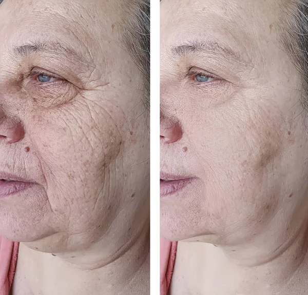 Πρόσωπό Της Μια Ηλικιωμένη Γυναίκα Πριν Και Μετά Τις Θεραπείες — Φωτογραφία Αρχείου