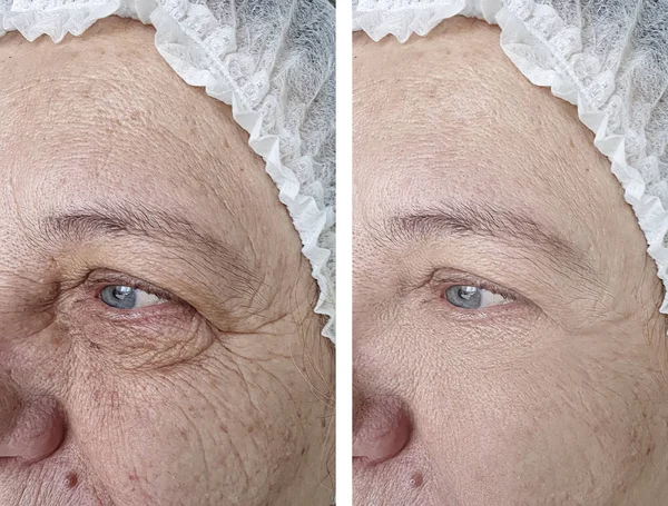 face of an older woman before and after treatments