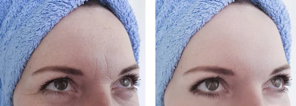 Arrugas Mujer Antes Después Procedimientos — Foto de Stock