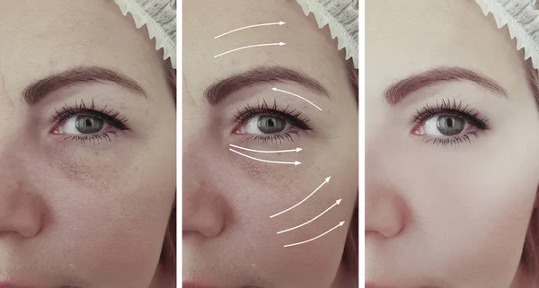 Wanita Keriput Wajah Sebelum Dan Setelah Prosedur — Stok Foto