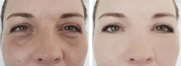 woman wrinkles face before and after treatments