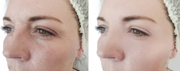 Γυναίκα Πρόσωπο Ρυτίδες Πριν Και Μετά Τις Θεραπείες — Φωτογραφία Αρχείου