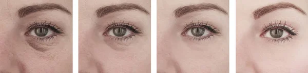 Female Eyes Wrinkles Procedures — Stock Photo, Image