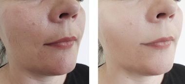 kadın kırışıklıkları yüz öncesi ve sonrası yordamları