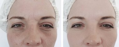 kadın kırışıklıkları yüz öncesi ve sonrası yordamları