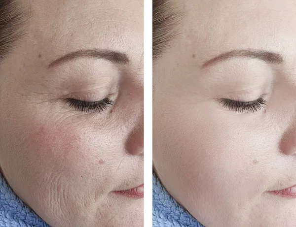 女性シワ顔の前に と後の手順 — ストック写真
