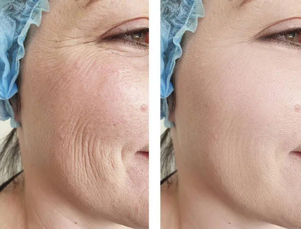 女性皱纹在治疗前后的脸 — 图库照片