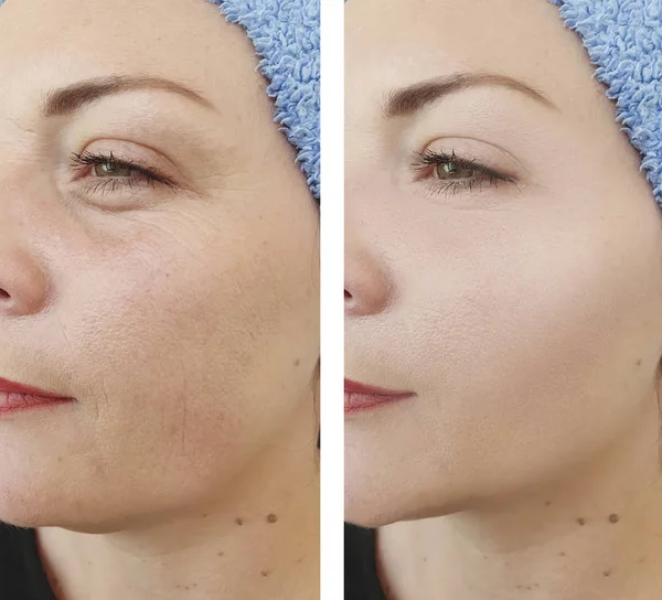 Arrugas Mujer Antes Después Los Tratamientos — Foto de Stock