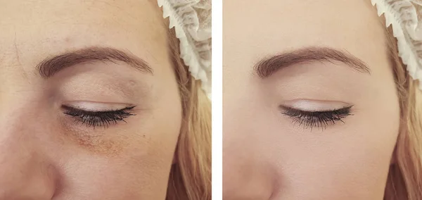 woman wrinkles before and after procedures