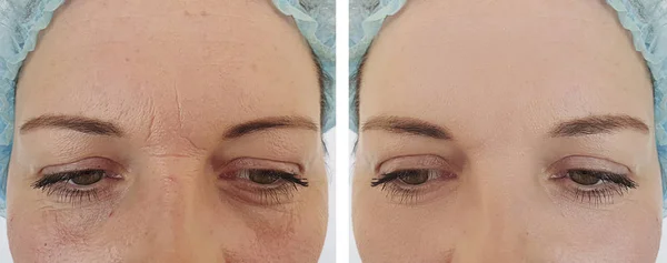妇女面孔皱纹在规程之前和之后 — 图库照片