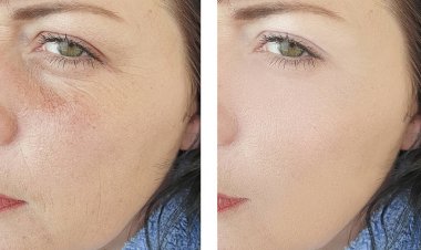 kadın yüz önce ve sonra kozmetoloji prosedürleri kırışıklıkları