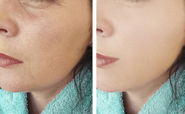 Arrugas Cara Mujer Antes Después Procedimientos Cosmetología — Foto de Stock